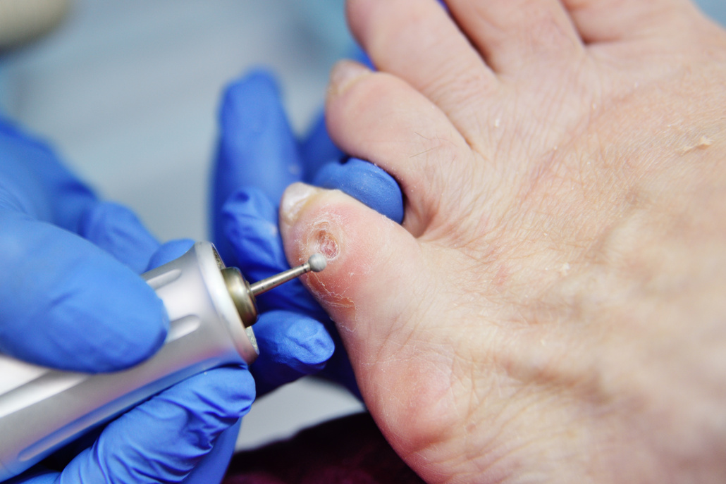 excision of calluses on the toe with a pedicure machine